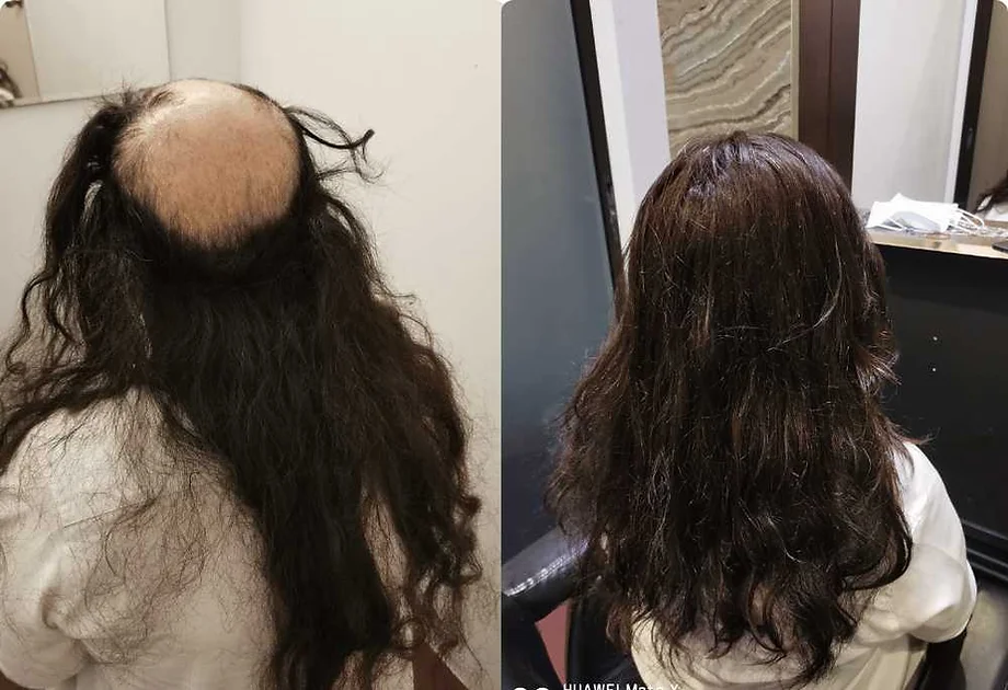 Avatar: Hair Replacement System Singapore Cost